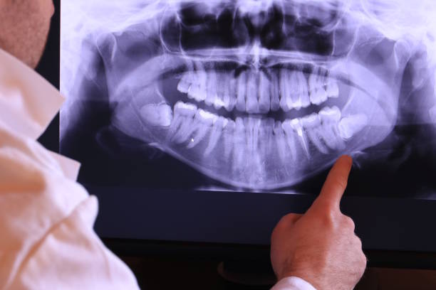 Best Emergency Wisdom Teeth Removal in Mount Pleasant, PA